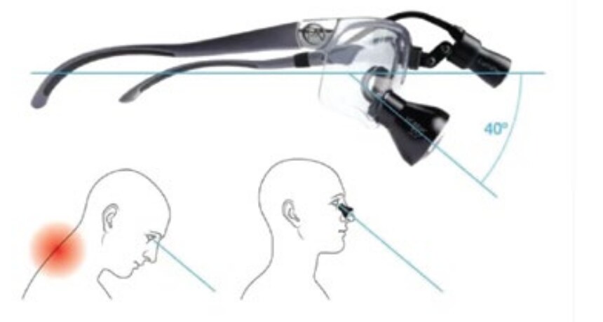Diagram of the 40 degree declination angle and neutral head posture
