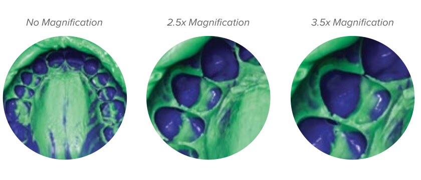 Comparison of no magnification, 2.5x and 3.5x magnification views